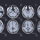 Image for article titled A tumor stole every memory I had. This is what happened when it all came back